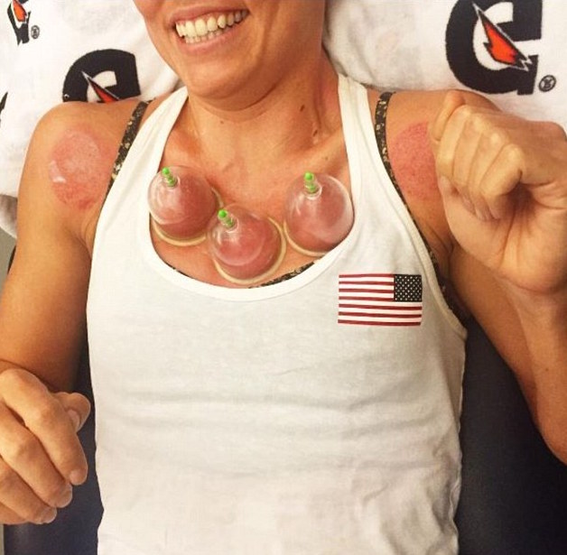 Olympic Athletes Performance Enhanced By Cupping Therapy New Windsor Orange County NY